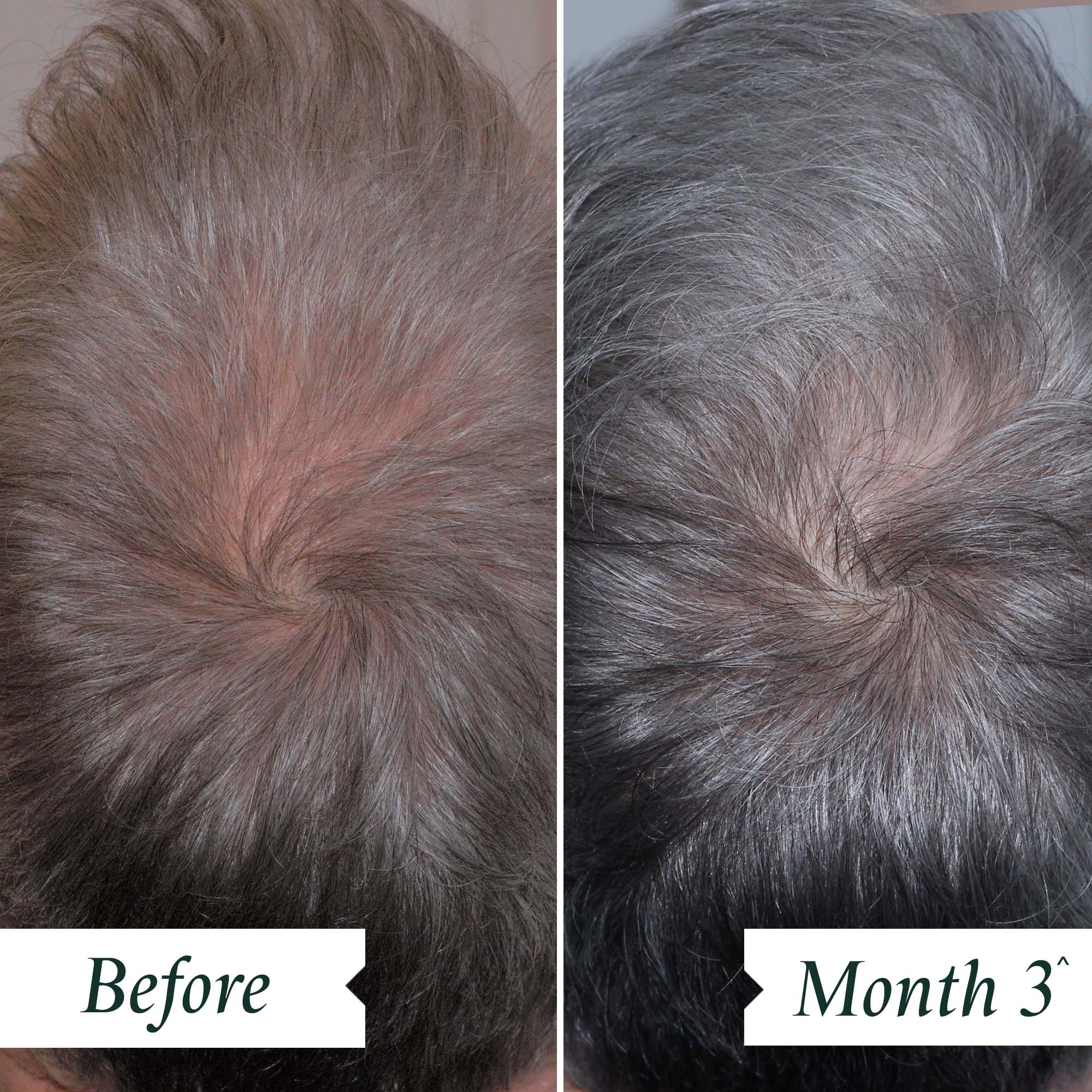 INDEPENDENT CLINICAL TRIAL – BEFORE AND AFTER 3 MONTHS OF CONTINUED DAILY USAGE OF DENSITY PRESERVING SCALP DROPS.