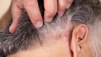 Psoriasis On Your Scalp: Causes, Symptoms & Expert Management